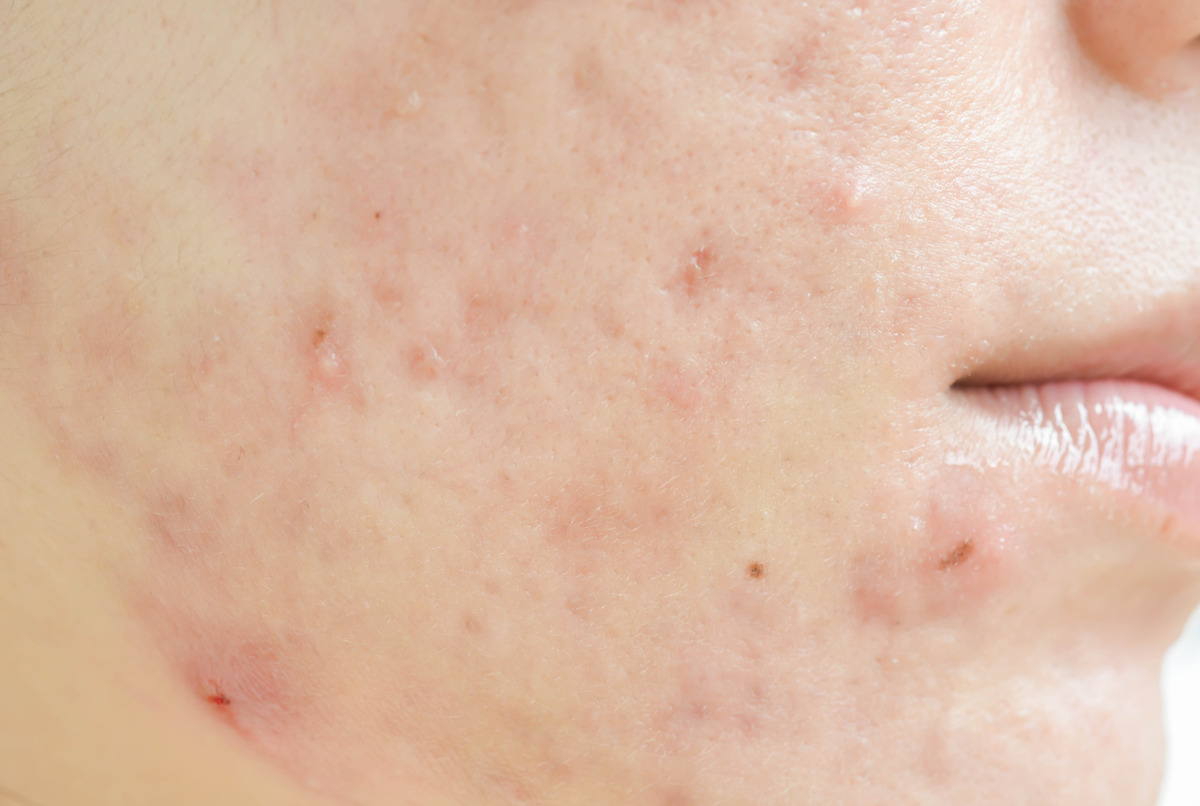 scar-from-acne-face