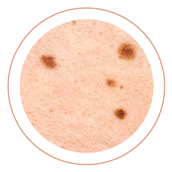 skin-cancer