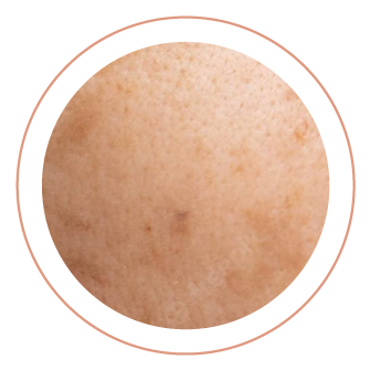skin-disorder