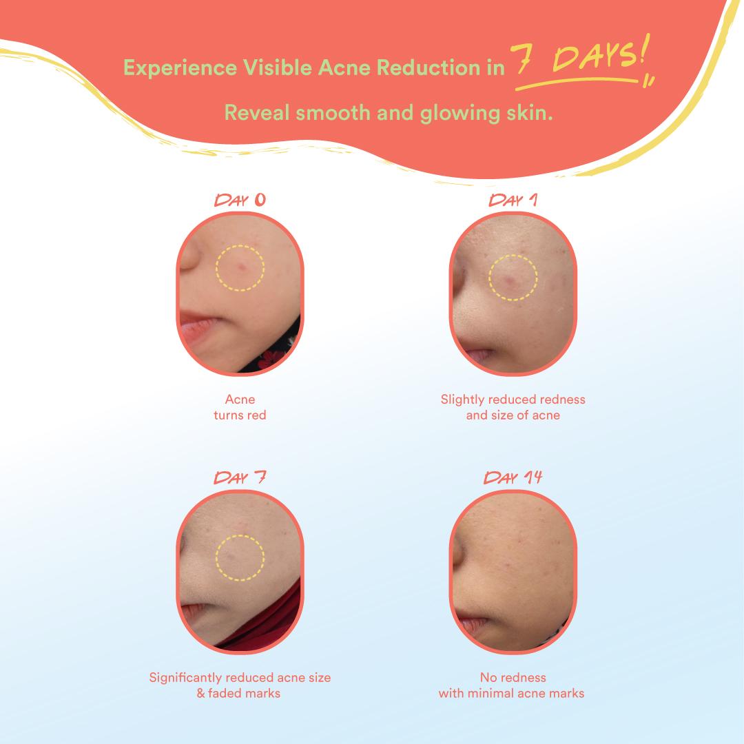 Why Ectoin Acne Gel?
